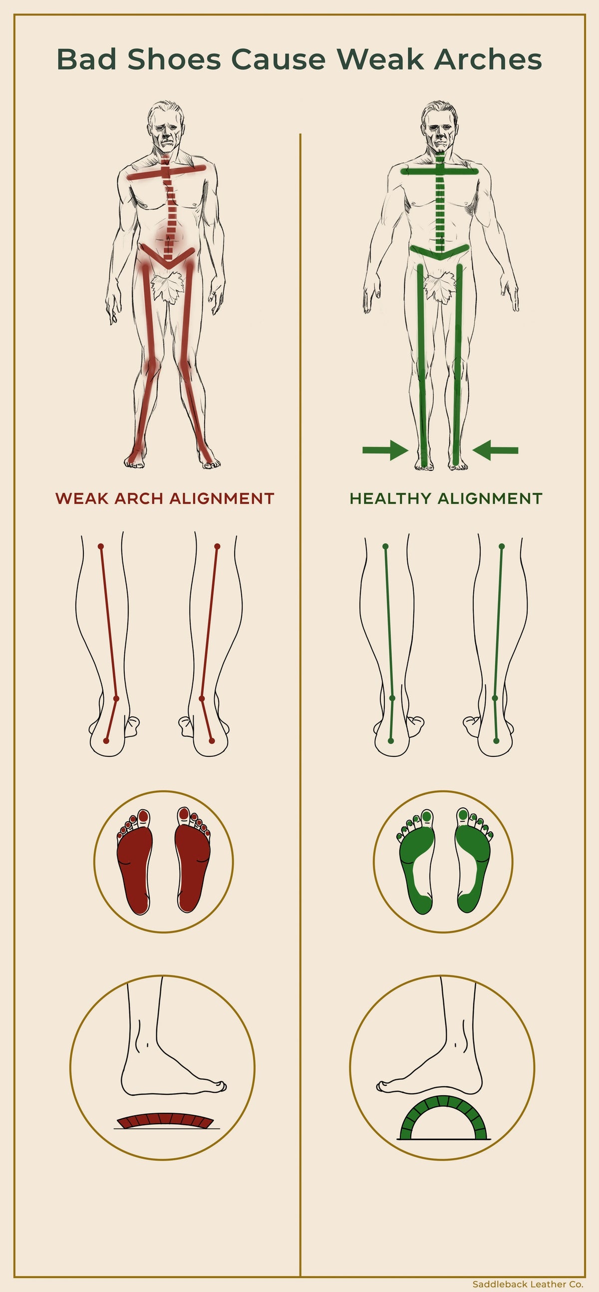 Bad Shoes Cause Weak Arches infographic comparing weak arch alignment with healthy body and foot alignment